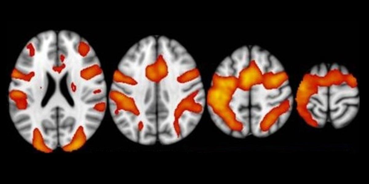 fMRI Image from Cloud et al, Scientific Reports 2026