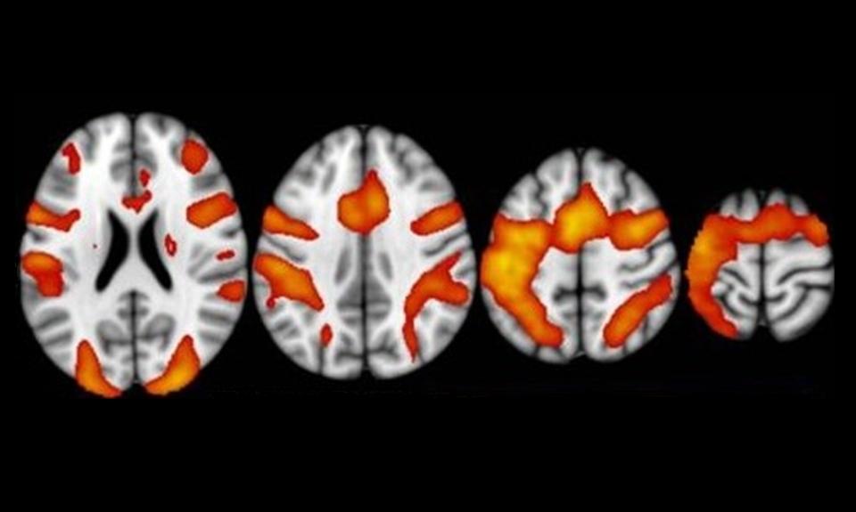 fMRI Image from Cloud et al, Scientific Reports 2026